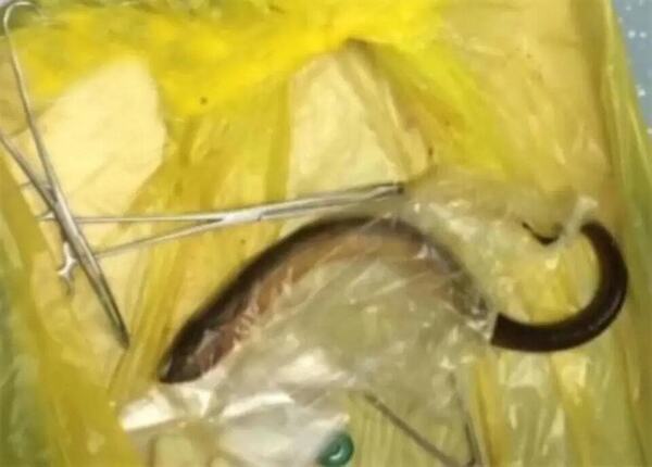 波蘭男為治便秘聽信偏方將活鰻魚插入肛門